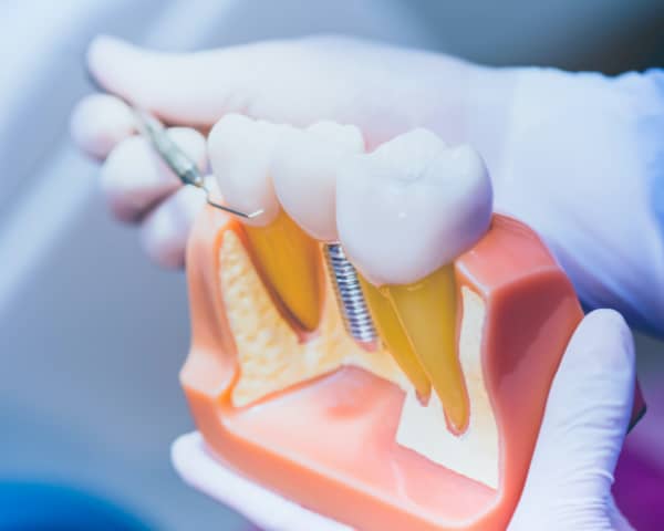 Dental Bonding Benefits for Tooth Repair - Perkins Dental Care